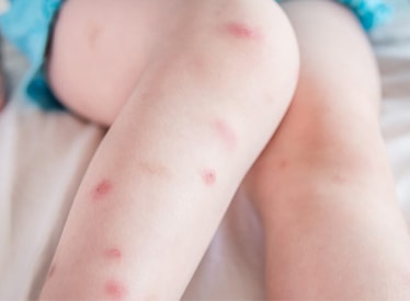 bed bugs bite legs